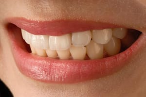 Veneers: Everything You Need to Know