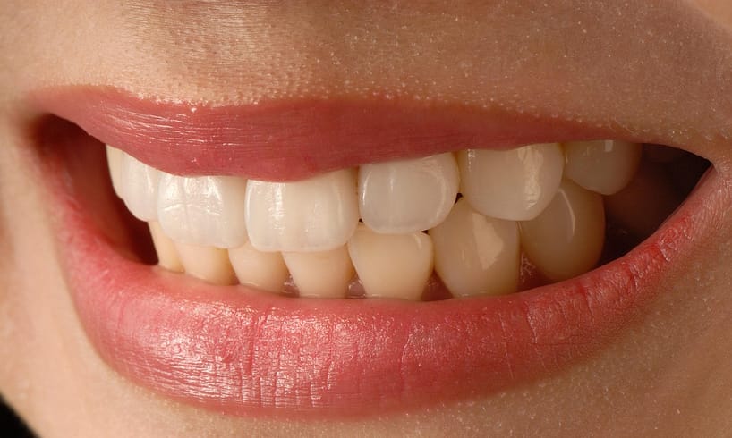 Veneers: Everything You Need to Know